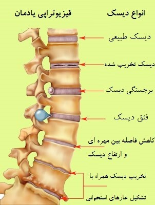 دیسک کمر