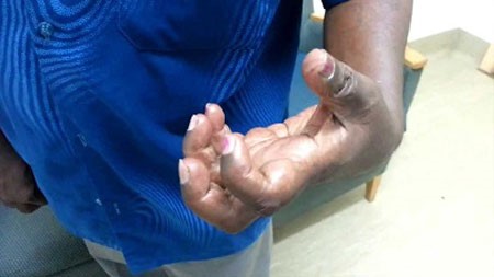 تاثیر سکته مغزی بر حرکات بدن