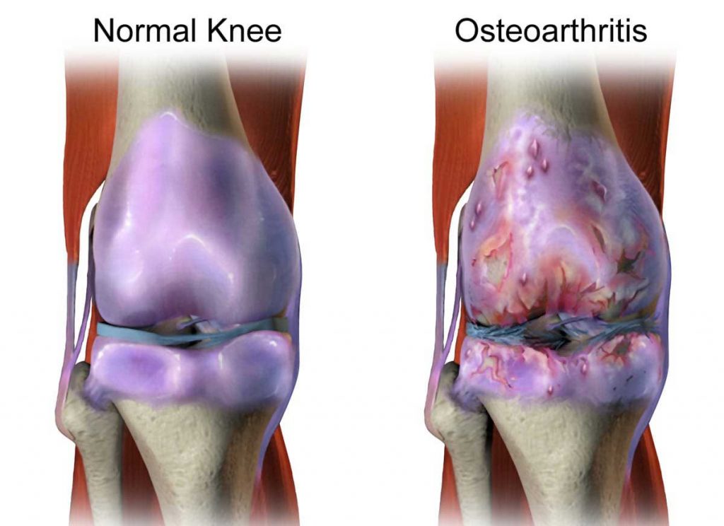 تشخیص آرتروز زانو