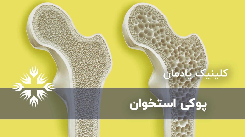 پوکی استخوان