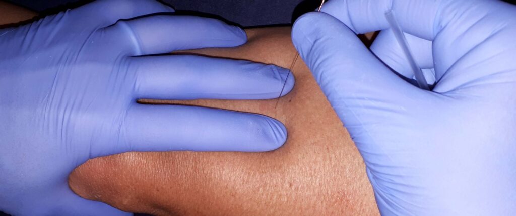 طب سوزنی در فیزیوتراپی
