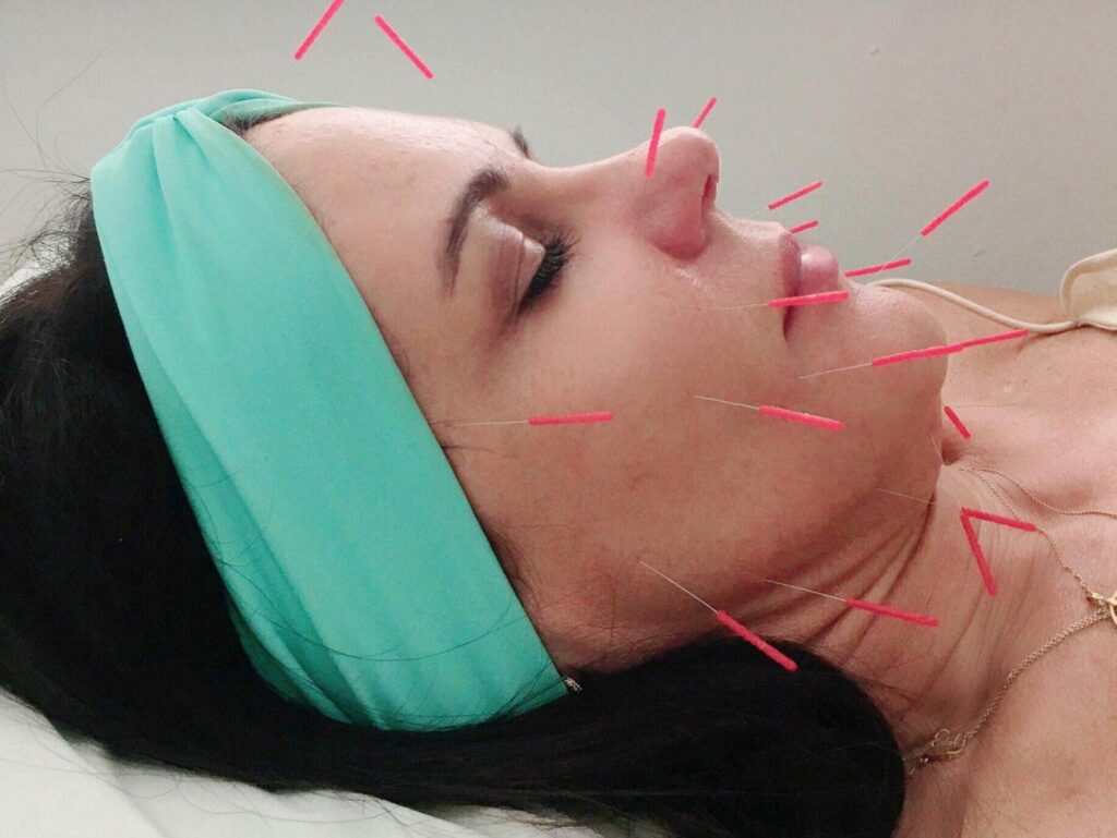 طب سوزنی برای زیبایی