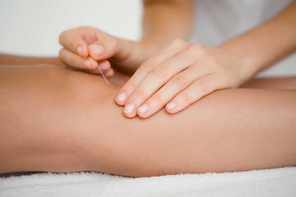 طب سوزنی برای آرتروز