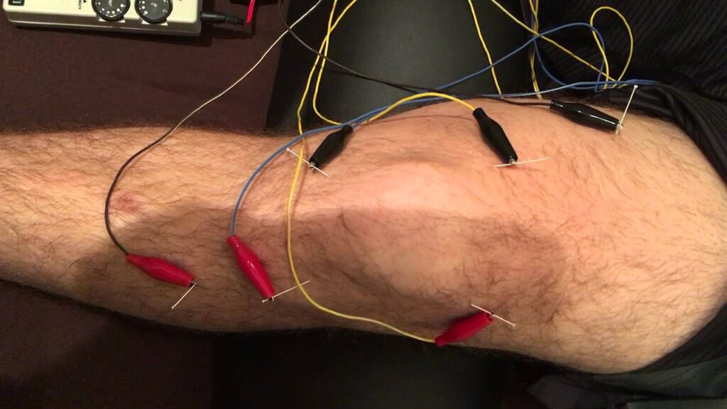 طب سوزنی الکتریکی