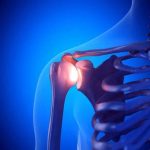 همه چیز درباره دررفتگی کتف: علائم، تشخیص و درمان