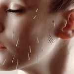 طب سوزنی برای زیبایی صورت