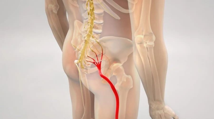 سیاتیک کدوم سمته