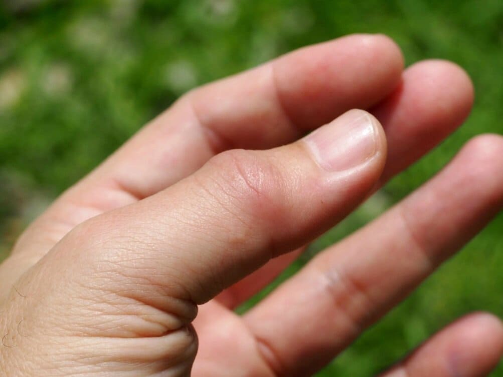 درمان خانگی ورم انگشت دست بر اثر ضربه